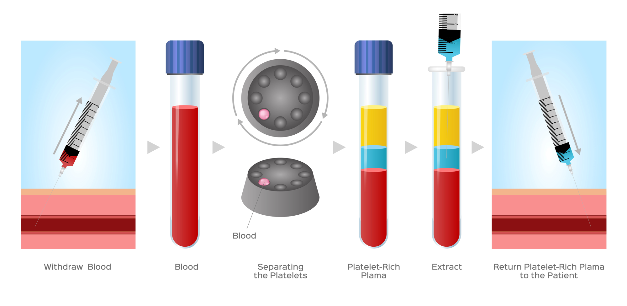 platelet rich plasma injection PRP