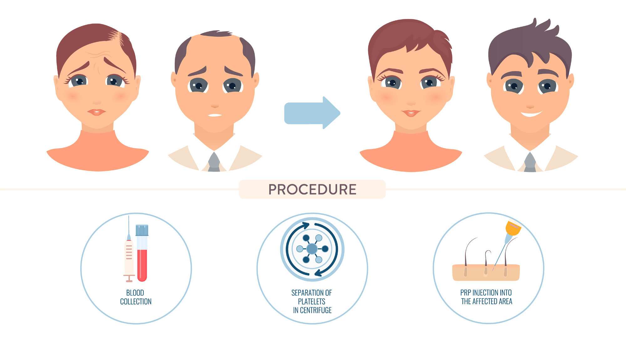 Platelet-Rich Plasma for hair procedure